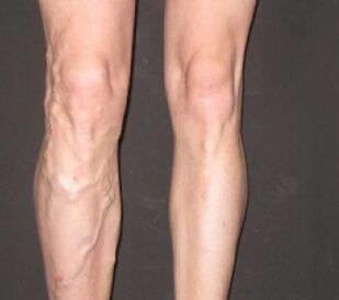 La varicosis progresa rápidamente
