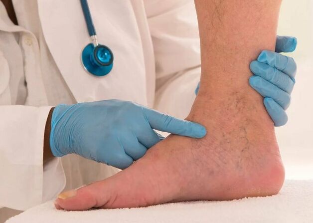 Varices
