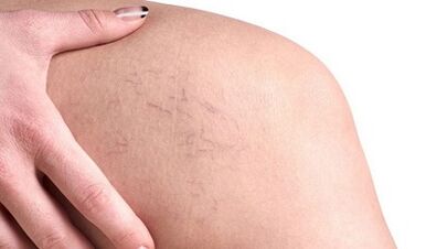 Cómo se manifestan las venas varicosas en las mujeres
