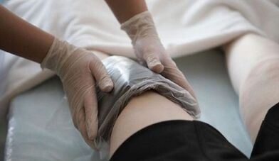 Métodos populares para el tratamiento de las venas varicosas en mujeres