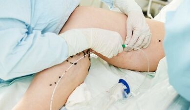 Métodos para el tratamiento de las venas varicosas en las piernas en mujeres