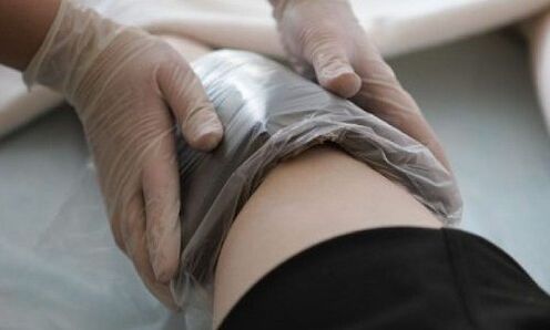 tratamiento de venas varicosas con compresas