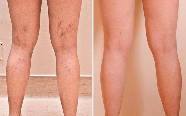 piernas antes y después del tratamiento de las venas varicosas