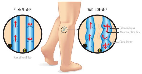 venas varicosas de las extremidades inferiores