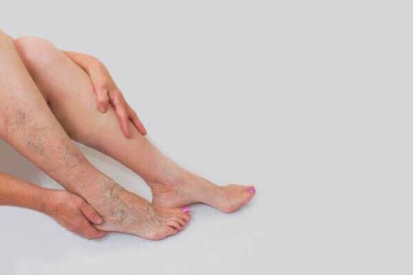 Las venas dilatadas y protuberantes son un signo de venas varicosas en las extremidades inferiores.