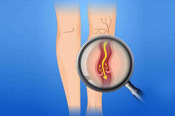 Válvula venosa afectada por venas varicosas